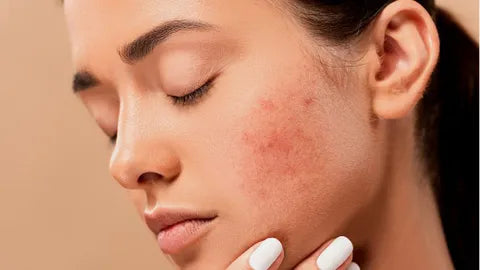 Cómo mantener la piel equilibrada y prevenir el acné adulto