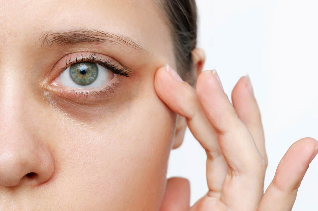Cómo Minimizar las Ojeras y las Bolsas Debajo de los Ojos: Consejos y Recomendaciones